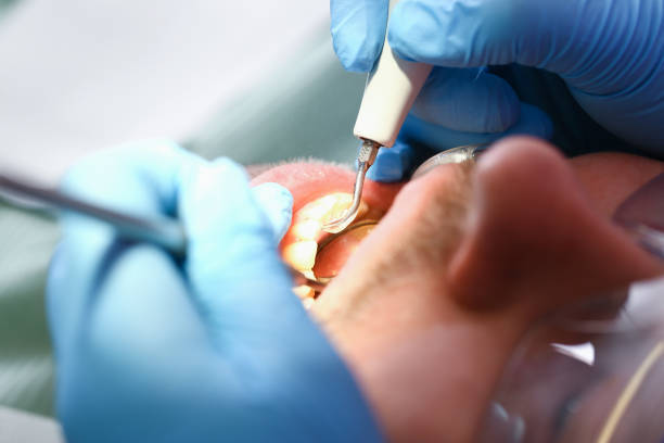 Best Emergency Treatment for Dental Infections or Abscesses in Osprey, FL