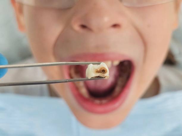 Best Emergency Tooth Extraction in Osprey, FL