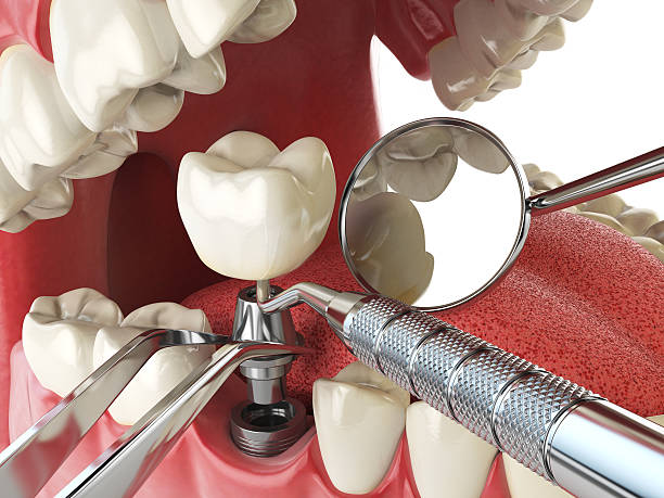 Best Emergency Dental Care for Broken or Chipped Teeth in Osprey, FL